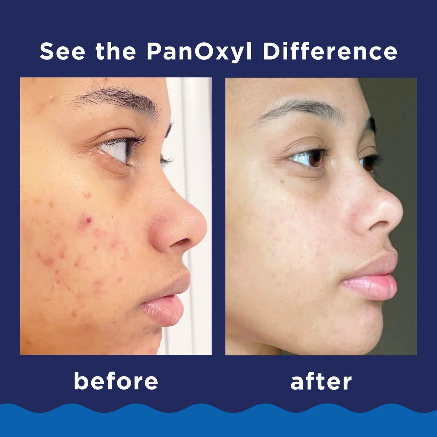 PanOxyl 10% Benzoyl Peroxide Acne Foaming Wash, 5.5 Oz